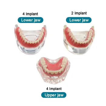 Dental Dentes Modelo com Implante de Sobredentadura Implante de Dentes Modelo Dental Modelo de Ensino de Três Tipos de